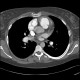 Chronic lung embolism, pulmonary hypertension, webs, adherent thrombi: CT - Computed tomography